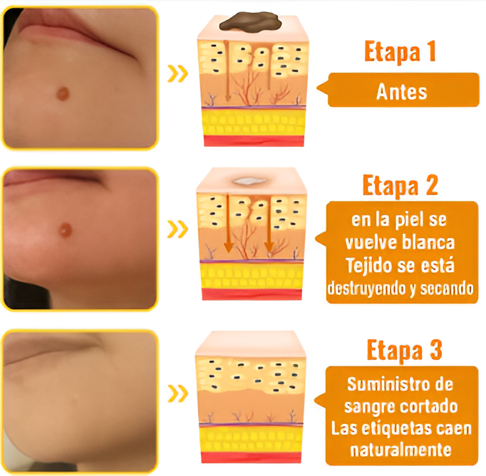Tratamiento para Verrugas y Lunares